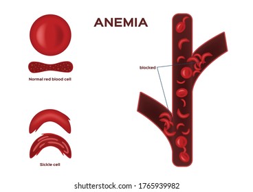 Normal Red Blood Cell And Sickle Cell Vector / Anemia On White