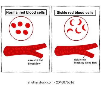 Normal Red Blood Cell And Sickle Cell.Anaemia Disease.Diagram Or Infographic.World Sickle Cell Day.Erythrocytes.Blood Flow Concept.Vector Illustration.