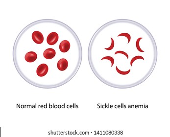 Comparison Between Normal Red Blood Cells Stock Vector (Royalty Free ...