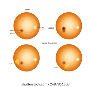 Normal retina and Macular degeneration: Drusen, Atrophy, Subretinal hemorrhage. 