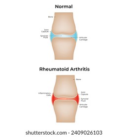 Normal and Rheumatoid Arthritis Science Design Vector Illustration