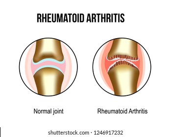 Normal and rheumatoid arthritis sore joints. For rheumatoid arthritis advertising, medical and studying publications. Vector illustration stock vector.