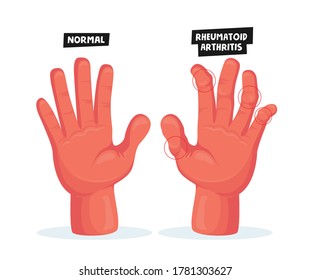 Normal And Sick Hands With Rheumatoid Arthritis. Finger Joints Inflammation Medical Healthcare Concept. Patient Treatment In Hospital. Osteoarthritis Autoimmune Disease. Cartoon Vector Illustration