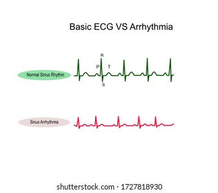 Normal Sinus Rhythm ECG and Sinus Arrhythmia ,NSR all complex evenly space P wave have QRS Complex rate 60-100 bpm but Sinus arrhythmia all complex normal but rhythmically irregular