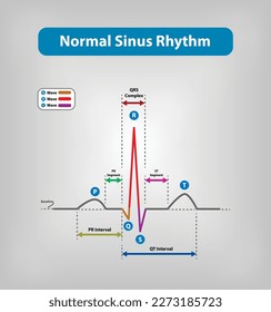 Normal Sinus Rhythm - showing standard waves, segments, and intervals. Rhythm of a healthy heart 
Vector and Illustration