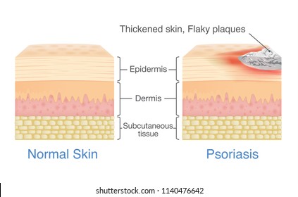 Normal skin layer and skin when plaque psoriasis signs and symptoms appear. illustration about dermatology diagram.