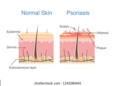 Normale Haut und Haut, wenn Plaque-Psoriasis-Zeichen und -Symptome auftreten. Abbildung über Hautdiagramm.