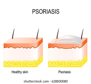 Normal Skin And Psoriasis. Plaque Psoriasis