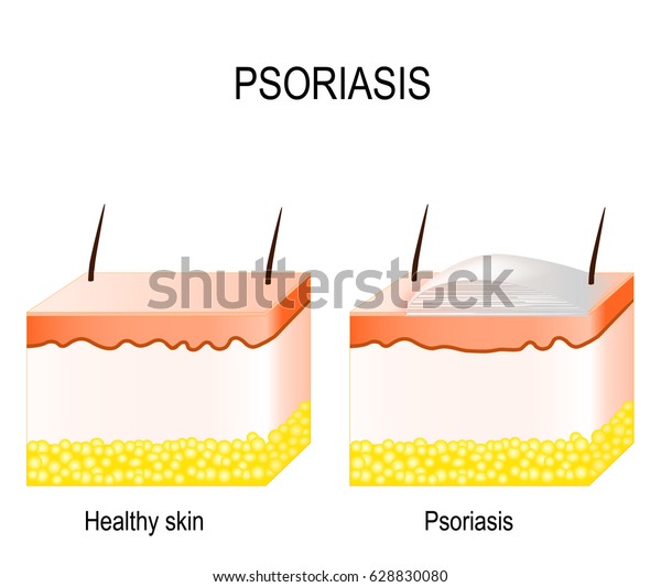 Normal Skin Psoriasis Plaque Psoriasis Stock Vector (Royalty Free ...