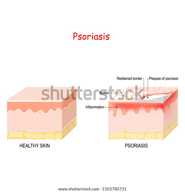 Normal Skin Psoriasis Signs Symptoms Skin Stock Vector (Royalty Free ...