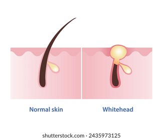 Normal skin and whitehead acne vector illustration isolated on white background. Whitehead, type of non inflammatory pimple. Closed comedone. Skin care and beauty concept.
