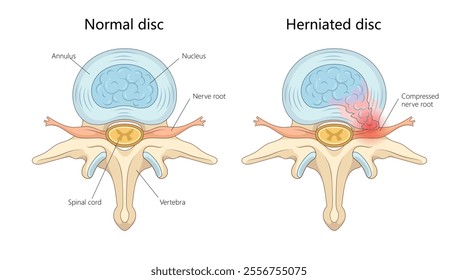 normal spinal disc and a herniated disc with compressed nerve root, labeled for clarity diagram hand drawn schematic vector illustration. Medical science educational illustration