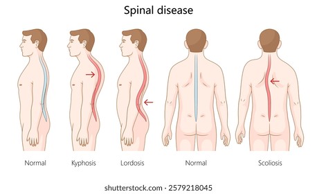 normal spine alignment with spinal disorders, including kyphosis, lordosis, and scoliosis, showing abnormal curves and posture diagram hand drawn vector. Medical science educational illustration