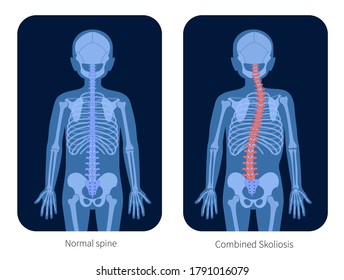 Normal spine and combined scoliosis in boy body. XRay flat vector illustration. Backbone, joint and skeleton anatomy in child silhouette. Orthopedic poster. Medical banner. Exam in spinal pain center.