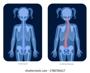 Scoliosis normal y combinada en el cuerpo de la niña. Ilustración vectorial plana XRay. Anatomía de espina dorsal, articulación y esqueleto en silueta infantil. Afiche ortopédico. Cartel médico. Examen en el centro del dolor medular