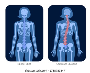 Normal spine and combined scoliosis in woman body. XRay flat vector illustration. Backbone and skeleton anatomy in female silhouette. Orthopedic poster. Medical banner. Exam in spinal pain center