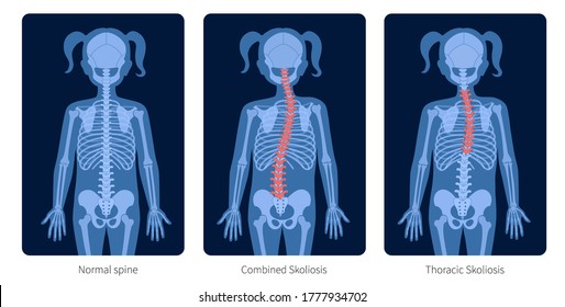 Normal spine, combined and thoracic scoliosis in child body. XRay flat vector illustration. Backbone and skeleton anatomy in girl silhouette. Orthopedic poster. Medical exam in spinal pain center