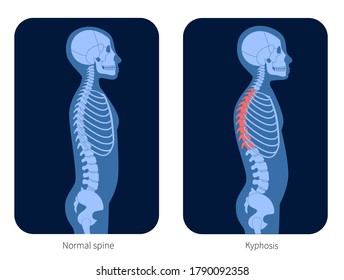 Normal Spine And Kyphosis In Child Body. XRay Flat Vector Illustration. Backbone And Skeleton Anatomy In Boy Silhouette. Orthopedic Poster. Medical Banner For Clinic. Exam In Spinal Pain Center