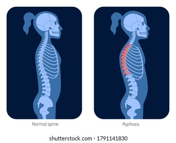 Normal spine and kyphosis in girl body. XRay flat vector illustration. Backbone and skeleton anatomy in child silhouette. Orthopedic poster. Medical banner for clinic. Exam in spinal pain center