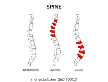 Comparação da coluna vertebral normal, cifose e lordose. Conceito de escoliose. Anatomia da coluna humana e condições de postura. Deformidades da coluna vertebral e tipos de curvatura ilustração vetorial plana, diagrama médico da vértebra