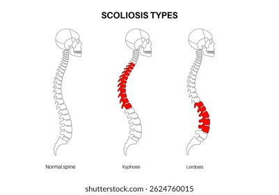 Comparação da coluna vertebral normal, cifose e lordose. Conceito de escoliose. Anatomia da coluna e escultura humanas, condições de postura. Deformidades da coluna vertebral, tipos de curvatura ilustração vetorial de contorno, diagrama de vértebra