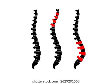 Comparação da coluna vertebral normal, cifose e lordose. Conceito de escoliose. Anatomia da coluna humana e condições de postura. Deformidades da coluna vertebral e tipos de curvatura ilustração vetorial plana, diagrama médico da vértebra