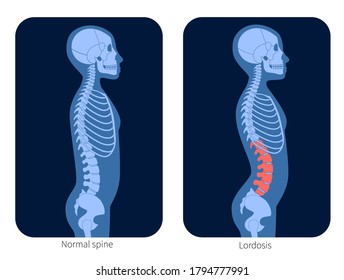 Normal Spine And Lordosis In Child Body. XRay Flat Vector Illustration. Backbone And Skeleton Anatomy In Boy Silhouette. Orthopedic Poster. Medical Banner For Clinic. Exam In Spinal Pain Center