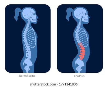 Normal spine and lordosis in girl body. XRay flat vector illustration. Backbone and skeleton anatomy in child silhouette. Orthopedic poster. Medical banner for clinic. Exam in spinal pain center