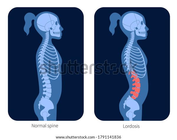 Normal Spine Lordosis Girl Body Xray Stock Vector (Royalty Free) 1791141836