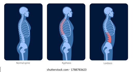 Sangre normal, lordosis y kyphosis. Scoliosis en el cuerpo masculino. Ilustración vectorial plana XRay. Anatomía de la espina dorsal y el esqueleto en la silueta humana. Afiche ortopédico. Examen médico en el centro de dolor de columna