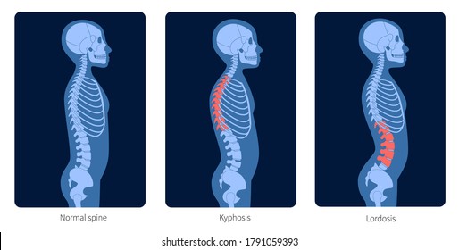 Normal Spine, Lordosis And Kyphosis. Scoliosis In Child Body. XRay Flat Vector Illustration. Backbone And Skeleton Anatomy In Boy Silhouette. Orthopedic Poster. Medical Exam In Spinal Pain Center