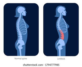 Normal spine and lordosis in woman body. XRay flat vector illustration. Backbone and skeleton anatomy in female silhouette. Orthopedic poster. Medical banner for clinic. Exam in spinal pain center