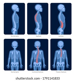 Normal spine and types of spine defects. Scoliosis in child body. XRay flat vector illustration. Backbone and skeleton anatomy in boy silhouette. Orthopedic poster. Medical exam in spinal pain center