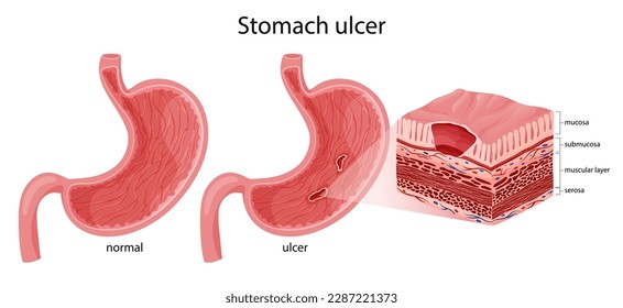 Normal stomach and peptic ulcer detailed illustration, white background, cartoon style
