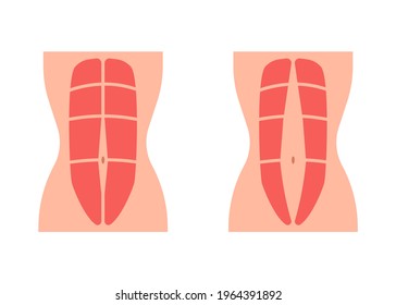 Normal tone muscle abdomen and diastasis recti, weak and divergence abdomen muscle. Rectus abdominal diastasis. Vector illustration