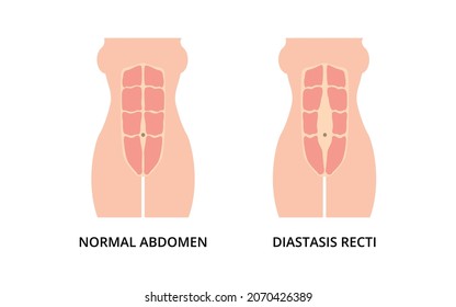 Normal toned abdomen muscles and diastasis recti, also known as abdominal separation, common among pregnant women