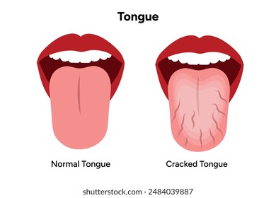 Problema de lengua normal y lengua agrietada 