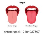 Normal tongue and strawberry tongue 