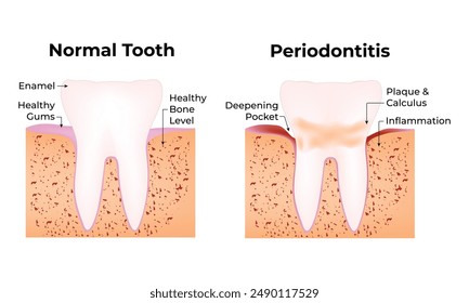 Normal Tooth and Periodontitis Science Design Vector Illustration Diagram