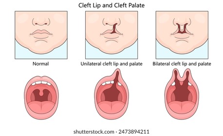 normal, unilateral cleft lip and palate, and bilateral cleft lip and palate conditions in infants diagram hand drawn schematic vector illustration. Medical science educational illustration