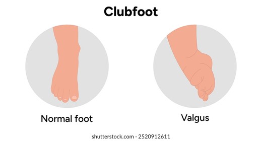 Normal e Valgus Clubfoot problema pé. Diagrama infográfico ortopédico