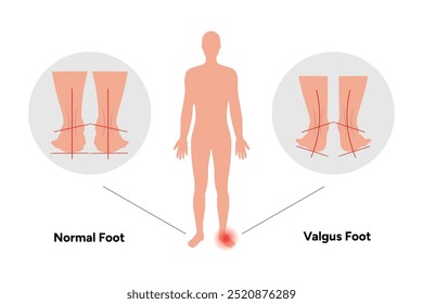 Normal and Valgus foot and footprint. Orthopedist diagram infographic