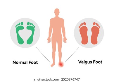 Normal and Valgus foot and footprint. Orthopedist diagram infographic