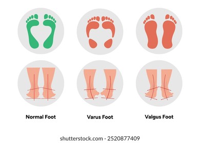 Normal, Valgus and varus foot and footprint. Orthopedist diagram infographic