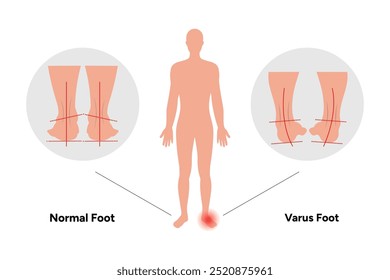 Normal and Varus foot and footprint. Orthopedist diagram infographic