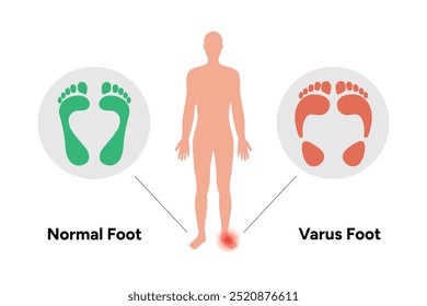 Normal and Varus foot and footprint. Orthopedist diagram infographic