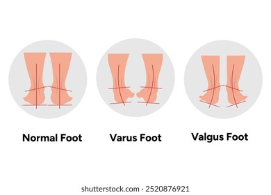 Pé e pegada normal, vago e valgo. Diagrama ortopédico infográfico