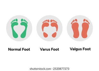 Pé e pegada normal, vago e valgo. Diagrama ortopédico infográfico