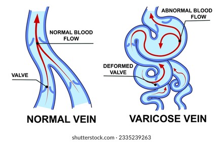 vena normal. Vena varicosa. Flujo sanguíneo. Ilustración vectorial. Ilustración sanitaria. 