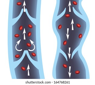 Normal Vein And Varicose Vein Illustration. Venous Insufficiency.